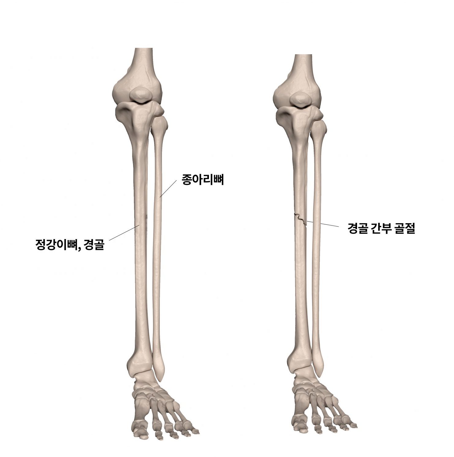 미세골절(스포츠 골절)을 포함한 스포츠 부상의 경우